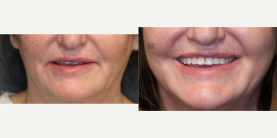 Enigmalift and fat transfer. - Enigmalift Browlift and eyelid lift with fat transfer and non-surgical neck tightening and lip lift.