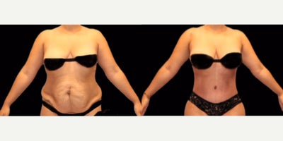 Woman treated with Tummy Tuck - Woman treated with Mommy Makeover, Liposuction, and Tummy Tuck