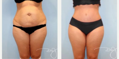 Woman treated with Tummy Tuck - Woman treated with Tummy Tuck