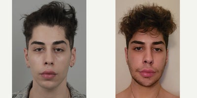 18-24 year old woman treated with V Line Surgery, Facial Fat Transfer, Cheek Implants - .