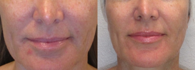 45-54 year old woman treated with PicoWay - Smooth and even skin tone to help provide a healthy youthful glow. However, fine lines, wrinkles, and blemishes can keep you from this goal. One of the biggest challenges in improving these concerns is that many of the technologies that address them:3 treatmentsNo recovery timeEncourages reformulation of collagenGood for all skin typesAddresses fine lines, discoloration Cost: $595.00 for the face and neck