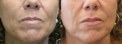 45-54 year old woman treated with Restylane - This patient had Restylane to enhance her lips and erase lines above the lip and also Botox to turn up the top lip slightly.