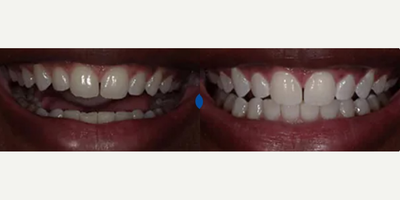 25-34 year old woman treated with Smile Makeover - 32 Year old patient wanted to treat herself to a refreshed and brighter smile just 9 weeks after pregnancy. After a relaxing Zoom! treatment (where she was able to catch a nap while pampering herself) Dr. D got her smile 11 shades lighter!