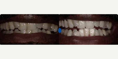 35-44 year old woman treated with Smile Makeover - 42 year old patient has been feeling really self-conscious about his smile and oral health. After a thorough cleaning and gum treatment Dr. D completed a one-hour Zoom! teeth whitening treatment and the results speak for themselves.