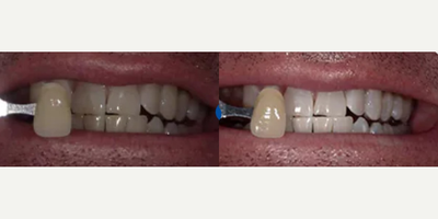 Woman treated with Smile Makeover - Woman treated with Smile Makeover