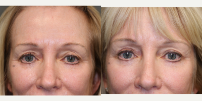 Revision eyelid surgery and lip lift - Lip filler corrected with lip lift and eyelid surgery revised on upper and lower lids, prior laser scaring corrected.