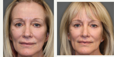 Revision eyelid surgery and lip lift - Lip filler corrected with lip lift and eyelid surgery revised on upper and lower lids, prior laser scaring corrected.