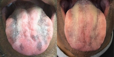 55-64 year old man treated with Laser Peel - After one ruby laser for tongue pigmentation. 6 weeks post treatment.