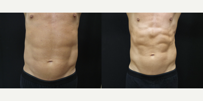 51 year old man 12 weeks after 1 SculpSure treatment - 51 year old man 12 weeks after 1 Sculpsure treatment.  Areas treated were lower abdomen and flanks.