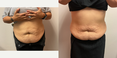 45-54 year old woman treated with Cryoskin - Cryoskin body contouring for slimming and toning! 3/5 treatments!