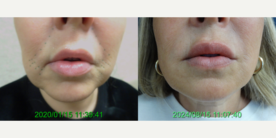55-64 year old woman treated with Juvederm, Restylane, Restylane Contour, Lip Fillers - Age: 55Post-op Photos Taken At: 4 yearsProcedure: Fillers to the Lips, Marionette Lines, Pre-Jowl Sulci, and Nasolabial Folds