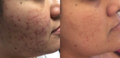 25-34 year old woman treated with SkinPen - Skin Pen Treatment for Acne Scars - 3 Treatments