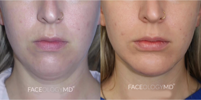 Woman treated with Chin Liposuction, Chin Implant - Heres the result of our patient who underwent submental liposuction and chin augmentation 6 months ago.Note the changes in her appearance at 6 months post-op over the course of her healing journey. The skin around her neck has become tighter, and her profile has been greatly enhanced.