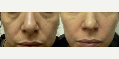 Woman treated with Dermal Fillers - Woman treated with Dermal Fillers