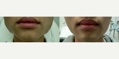 Woman treated with Botox for TMJ - Woman treated with Botox for TMJ