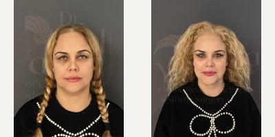 35-44 year old woman treated with Canthoplasty, Brow Lift, Eyelid Surgery - temporal lifting