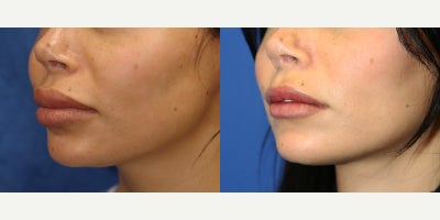 Upper and Lower Lip Silicone Removal surgery for Firmer Healthier Contour - A more natural lip appearance can often be achieved by carefully removing harmful foreign material from the lips. Our patient is a 28-year-old White female who came to Dr. J. Timothy Katzen because of previously injected foreign bodies in both her upper and lower lips. She was most concerned about the retained material, the scar tissue surrounding it, and the risk of granulomas and associated cancer. To treat these issues, Dr. Katzen performed silicone injection removal of the lips under general anesthesia. In this procedure, the abnormal injected material is carefully identified within the lip tissue and surgically excised. At the same time, any problematic scar tissue is also addressed to help restore a smoother contour. Lip foreign body removal is an advanced reconstructive procedure because the surgeon must remove harmful material without overly disrupting the natural architecture of the lips. These injections can cause chronic swelling, firmness, nodules, uneven shape, and visible lip distortion that cannot be corrected without surgery. By removing the foreign bodies and refining the tissue, this procedure can improve both safety and appearance. Her after photos were taken just 2 weeks after surgery and already show remarkable results, including better symmetry, softer-looking lips, and a healthier overall contour. Since healing is still in the early phase, her progress is especially impressive and should continue to improve over time.