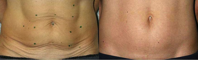 Woman treated with Skin Tightening - Woman treated with Skin Tightening