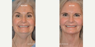 Woman treated with SMAS Facelift - Woman treated with Deep Plane/SMAS Facelift, Neck Lift, and Full Face Laser Resurfacing to achieve smooth skin, lifted contours, and a more youthful appearance  all while preserving her natural expressions.