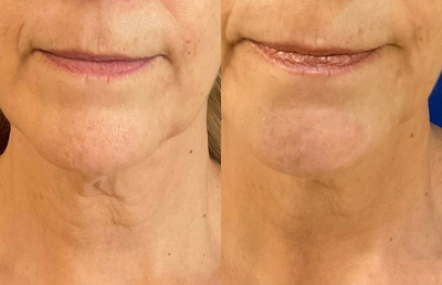 Woman treated with Sofwave - Photo provided courtesy of Sofwave, performed by Anna Buinewicz, MD