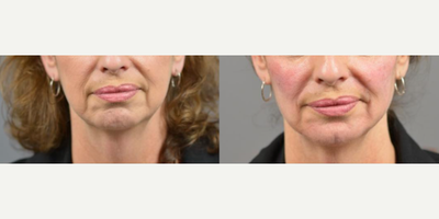 Woman treated with Dermal Fillers, Juvederm, Voluma - A Volume Lift is similar to a liquid facelift because only dermal fillers are used to achieve the desired result. Our goal with Volume Lift is to restore the youthful V shape and contour of the face by strategically, artfully and uniquely placing multiple syringes of filler using the same technique Dr. Marotta uses during a fat transfer procedure. The amount of filler needed to achieve the desired results is determined by your provider.Here is a patient who desired a more defined jawline but wasnt quite ready for surgical intervention. Our nurse injector was able to add visible contour and definition with multiple syringes of Juvederm Voluma to the cheeks, mandibular angle, pre-jowl sulcus and chin. After photo shown is immediately after injection.