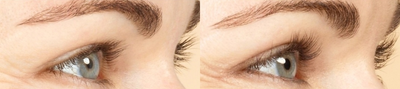 Latisse - Before and After Rhinoplasty by Dr. Ward at the University of Utah