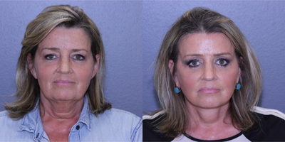 45-54 year old woman treated with Lifestyle Lift - Patient had Lifestyle Lift, Upper and Lower Bleph, and a Brow Lift