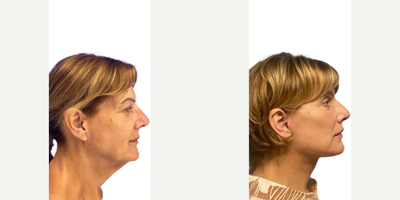 65 year old woman treated with Deep Plane Facelift - 65 year old woman treated with Deep Plane Facelift as well as Lip Lift, Brow Lift, Eyelid Blepharoplasty, and Facial Fat Transfer. Pre-op, patient was unhappy with her jowls, eyes, and lack of jaw definition.