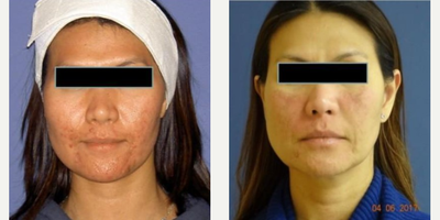 Woman treated with Laser Genesis - Genesis for Acne Treatment