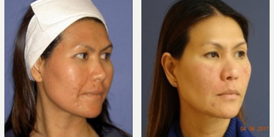 Woman treated with Laser Genesis - Genesis for Acne Treatment