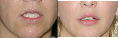 Upper Lip Lift, Fat Transfer and Lower FATMA - Upper Lip Lift, Fat Transfer and Lower FATMA Upper Lip lift&nbsp;