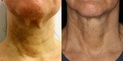 65-74 year old woman treated with Infini RF - 66 year old woman treated with Genius Microneedling with Radiofrequency and topical Sculptra to reduce tech neck / text neck creases