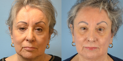 65-74 year old woman treated with ArteFill - 72 year old female received Artefill to cheeks, nasolabial folds, and marionette lines