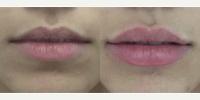 18-24 year old woman treated with Lip Fillers - This 20 year old female patient desired fuller lips. So, Dr. Katzen used Restylane filler to achieve a plump lip augmentation. Restylane is a FDA-approved filler which can be used throughout the body. It is an excellent way to correct deep nasolabial folds, lip augmentation and cheek augmentation.