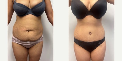 35-44 year old woman treated with Tummy Tuck - 4 months after an abdominoplasty, liposuction and muscle tightening