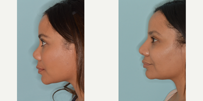 25-34 year old woman treated with Rhinoplasty - Dr. Bared describes his techniques for the refinements in a patient with a very low nasal bridge using her own, natural cartilage and avoiding the use of an artificial implant in the nose.