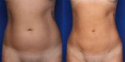 25-34 year old woman treated with Liposuction, Brazilian Butt Lift - 25 year old female shown 6 weeks after lipo 360 as well as fat transfer to her buttocks. She had 2.5 L fat removed and 650 cc of fat placed to each buttock.