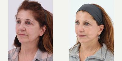 55-64 year old woman treated with Facelift, Neck Lift, CO2 Laser - 62 year old patient 7 months after a Facelift, Neck lift and CO2 laser