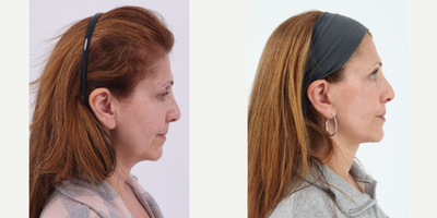 55-64 year old woman treated with Facelift, Neck Lift, CO2 Laser - 62 year old patient 7 months after a Facelift, Neck lift and CO2 laser