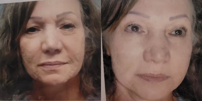 65-74 year old woman treated with Nonsurgical Facelift - woman in her 60s with long previous history of acne and scarring with significant skin sag who underwent non surgical face lift