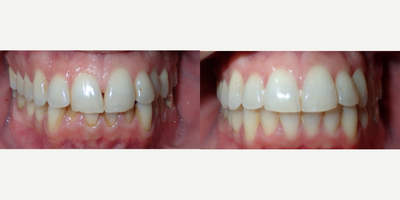 35-44 year old man treated with InBrace - Patient did not like his crowding and increased overbite. Treatment time 15 months.