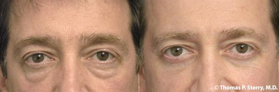 46 year old man treated with Eyelid Surgery - 46 year old man treated with Eyelid Surgery