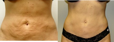 35-44 year old woman treated with Velashape - 35-44 year old woman treated with Velashape