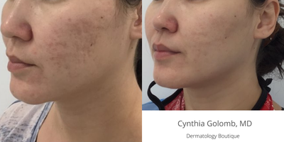 25-34 year old woman treated with Lutronic Genius RF - This patient with acne scars had both a Genius treatment and a light CoolPeel CO2 laser procedure on the same day. The after photos were taken 5 months later, when she came in for her second Genius treatment.