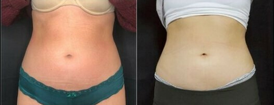 Woman treated with Cryoskin - Woman treated with Cryoskin