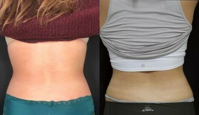 Woman treated with Cryoskin - Woman treated with Cryoskin