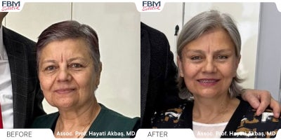 55-64 year old woman treated with Facelift, Deep Plane Facelift, Neck Lift, Facial Fat Transfer, Eyelid Surgery, Lip Lift - 55-64 year old woman treated with Facelift, Deep Plane Facelift, Neck Lift, Facial Fat Transfer, Eyelid Surgery, Lip Lift