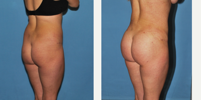 35-44 year old woman treated with Brazilian Butt Lift - Fat transfer of 400cc to each buttock following liposuction of hips and lower back.
