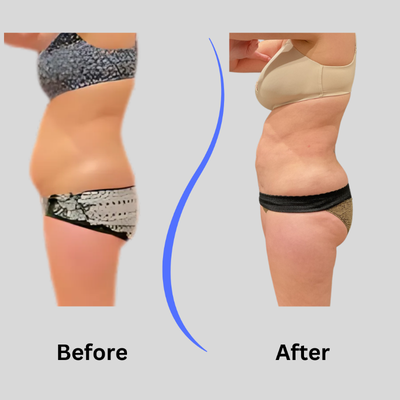 48 year old woman treated with Funsculpting HD Liposuction - Abs/Belly fat removal procedure, Funsculpting at Blue Wolf Transformations. 6 months later results.