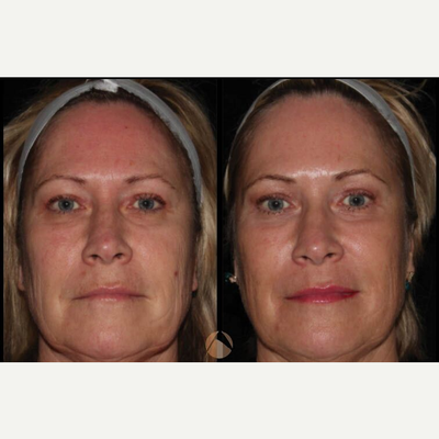Woman treated with CO2 Laser - CO2RE, Fractional CO2 Resurfacing treatment